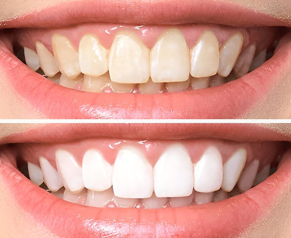 Before and after teeth whitening comparison showing stained vs. bright white teeth