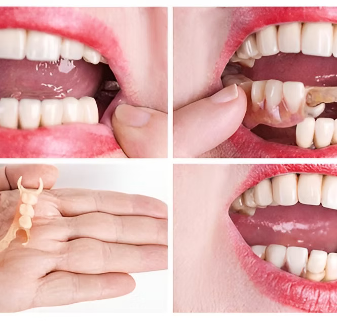 Step-by-step process of fitting a partial denture