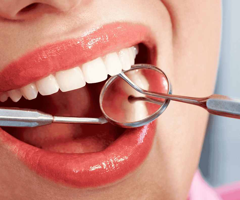 Close-up of a dental examination showing teeth after bonding treatment