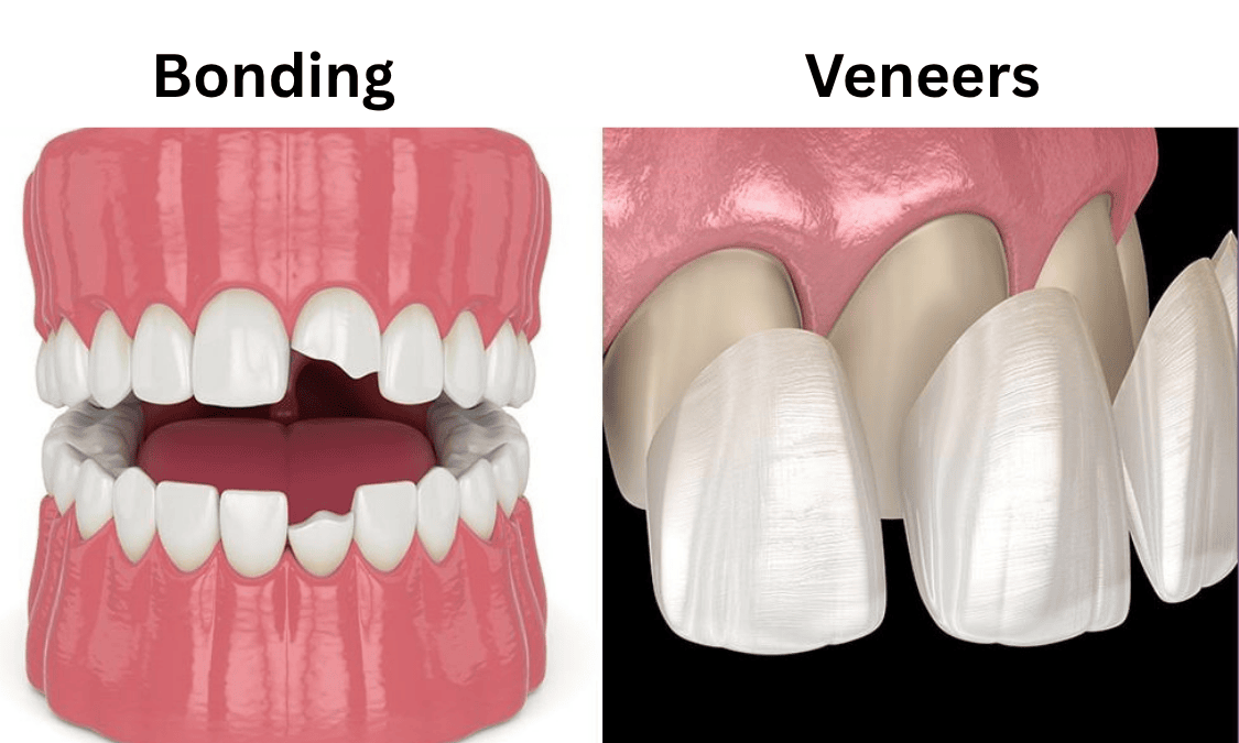 Dental illustration comparing bonding and veneers treatments