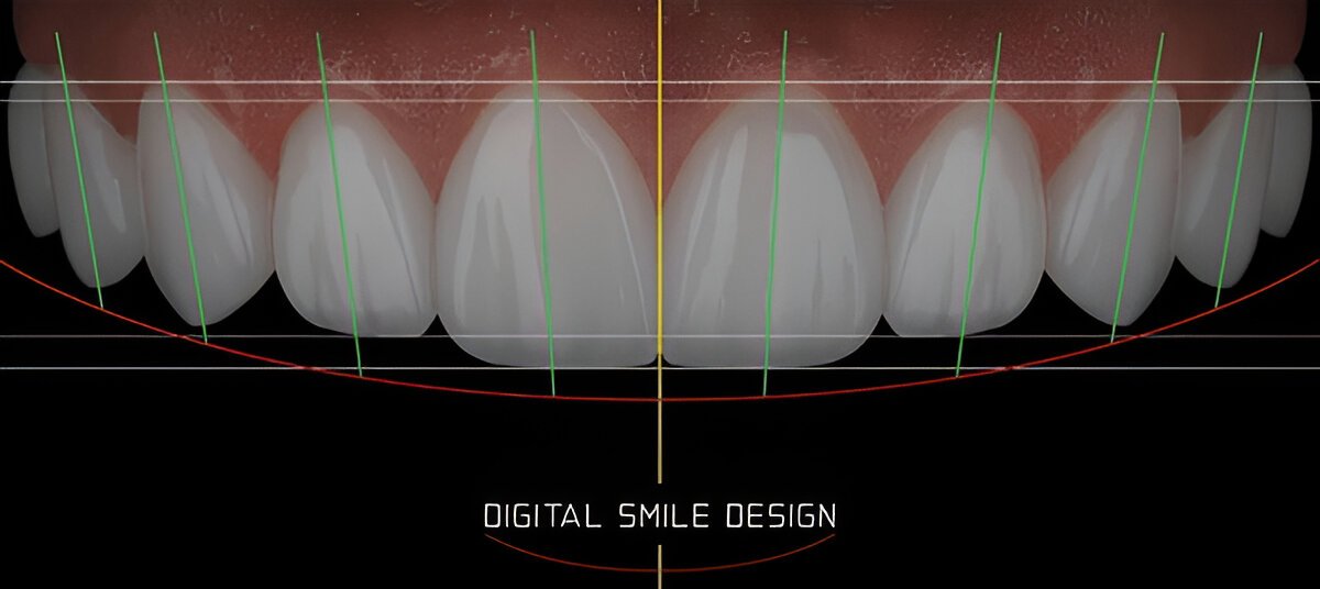 dental veneers